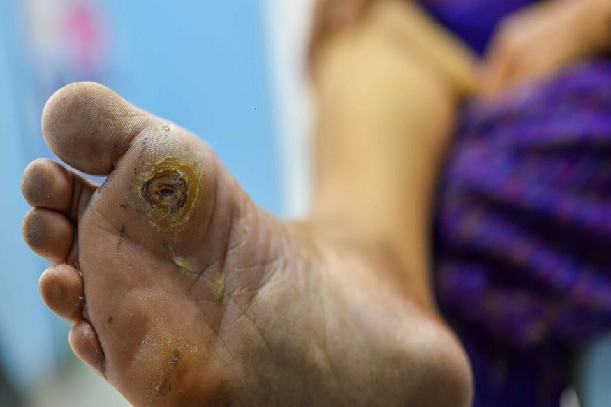 How to Treat Diabetic Foot Ulcers